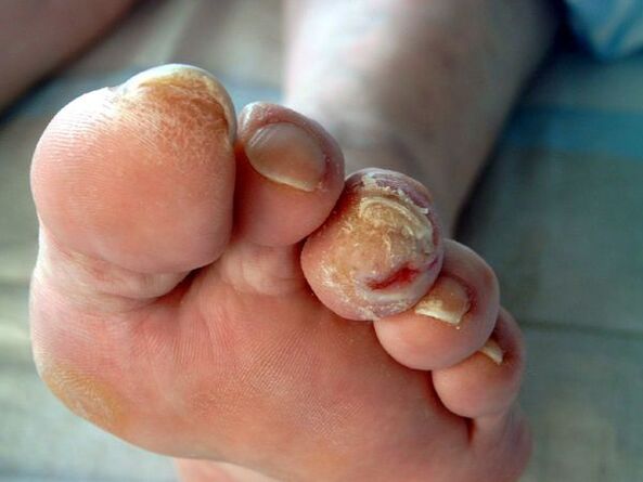 Këmbë diabetike dhe onychomycosis