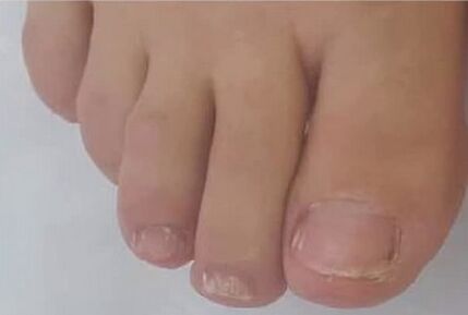 band Fungent band shpejt u shpëtua nga Mycosis